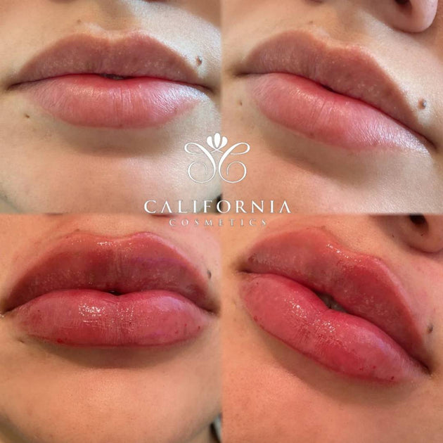 lip tenting before and after Book PERFECT Pout JUVÉDERM® Package