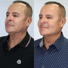 Chin augmentation before and after photos from California Cosmetics.