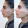 Chin enhancement before and after photos from the California Cosmetics Med Spa in Newport Beach.
