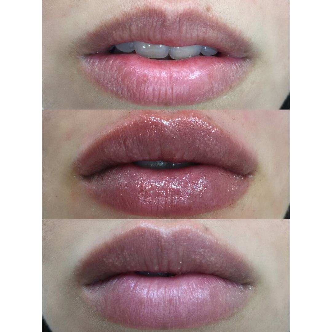 Book Custom Lip Augmentation Package | California Cosmetics
