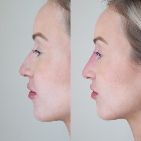 side facial profile photo before and after juvederm results