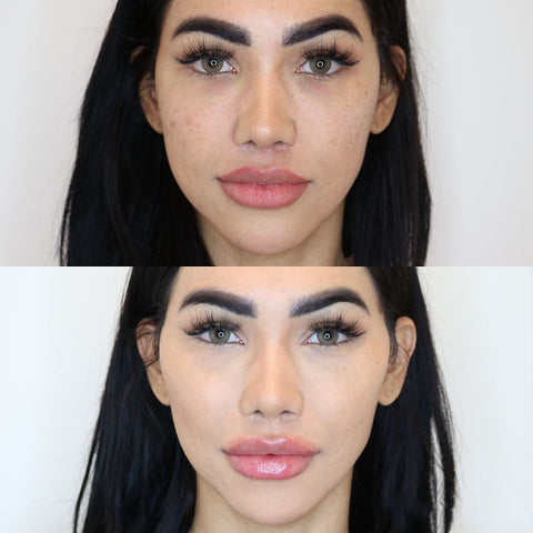 before and after photo front facial profile of juvederm filler