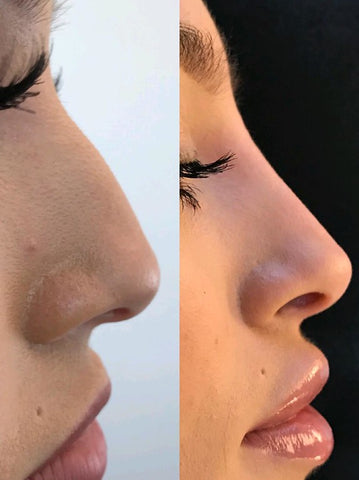 juvederm dermal filler close up of lips before and after