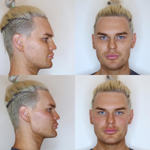 male patient juvederm filler before and after (side and front facial profile photos)