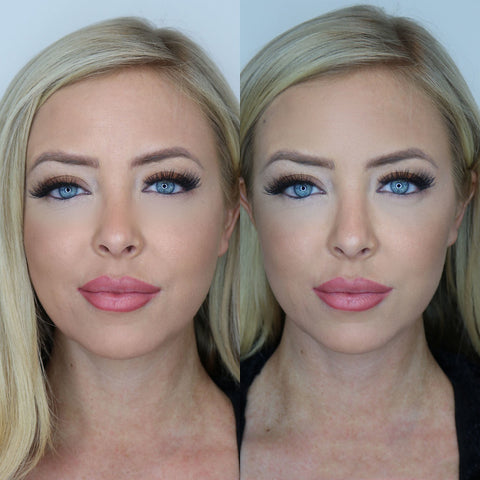 Juvederm filler before and after