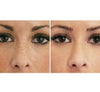 Cutera® IPL Photofacial Treatment