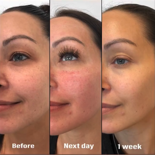 PRP Facial treatments