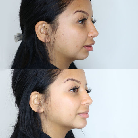 before and after photo of side profile of face related to juvederm filler photo