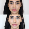 Cheek fillers and augmentation - before and after photos from California Cosmetics.