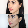 Cheek fillers - before and after photos from the California Cosmetics Med Spa in Corona.