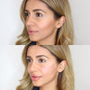 Cheek fillers - before and after photos from the California Cosmetics Med Spa in Newport Beach.