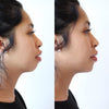 Chin augmentation before and after pics from the California Cosmetics Med Spa in Corona.
