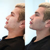 Chin augmentation before and after pics from the California Cosmetics Med Spa in Newport Beach.