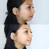 Chin enhancement before and after photos from the California Cosmetics Med Spa in Corona.