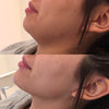 Chin fillers before and after photos from the California Cosmetics Med Spa in Corona.