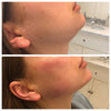 Chin reshaping before and after photos from California Cosmetics.