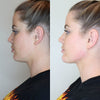 Chin shaping before and after photos from California Cosmetics.