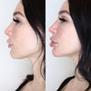 Chin reshaping before and after pics from the California Cosmetics Med Spa in Corona.