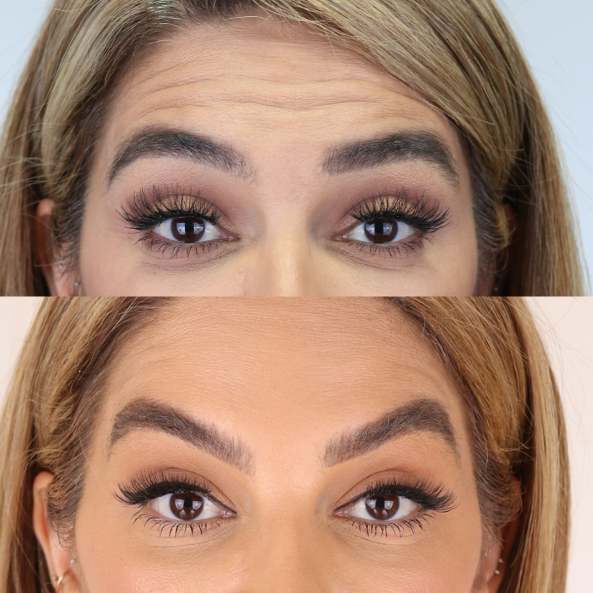 BOTOX® Injections | Lips | Frown Lines | Forehead | Armpits | Neck ...