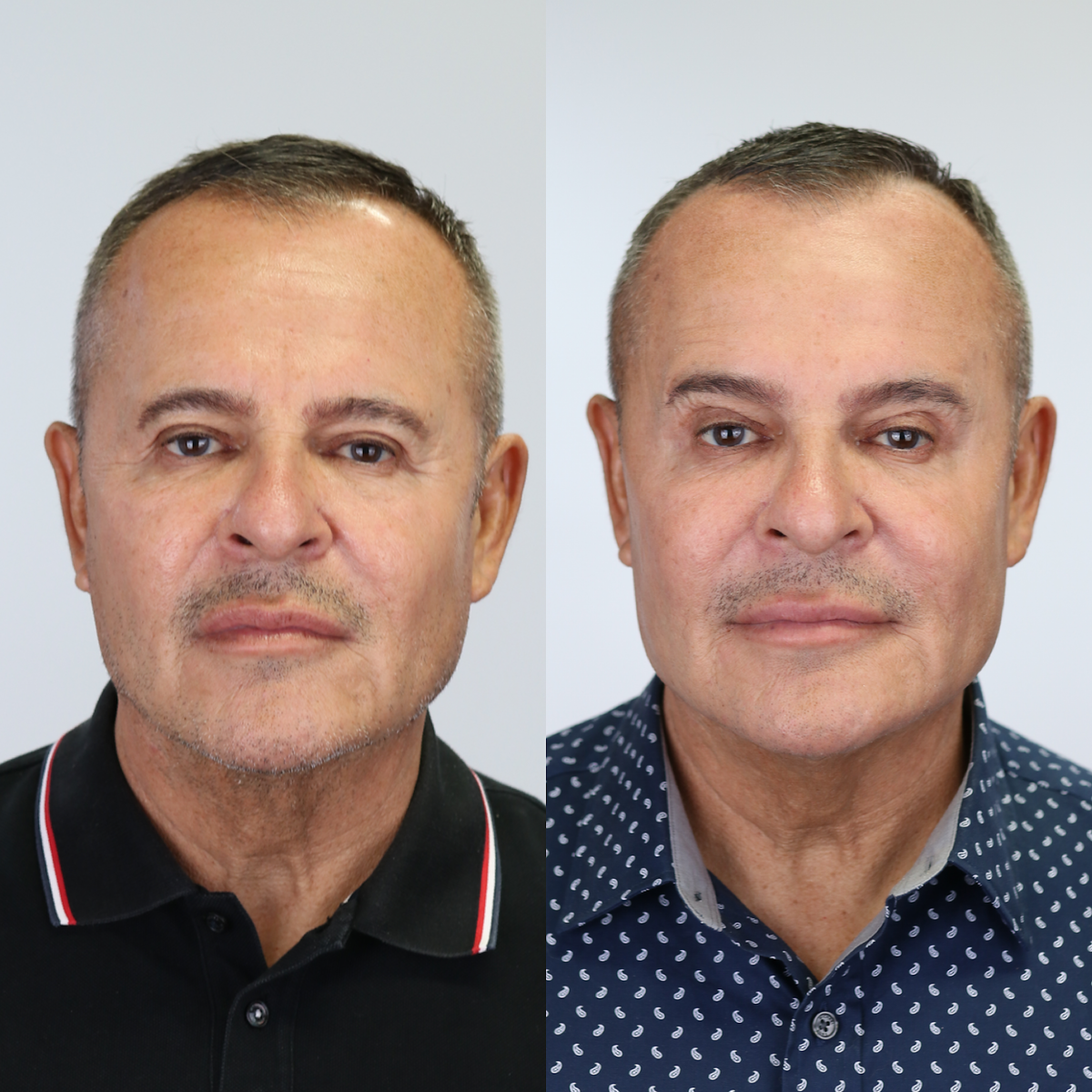 BOTOX® Injections | Lips | Frown Lines | Forehead | Armpits | Neck ...