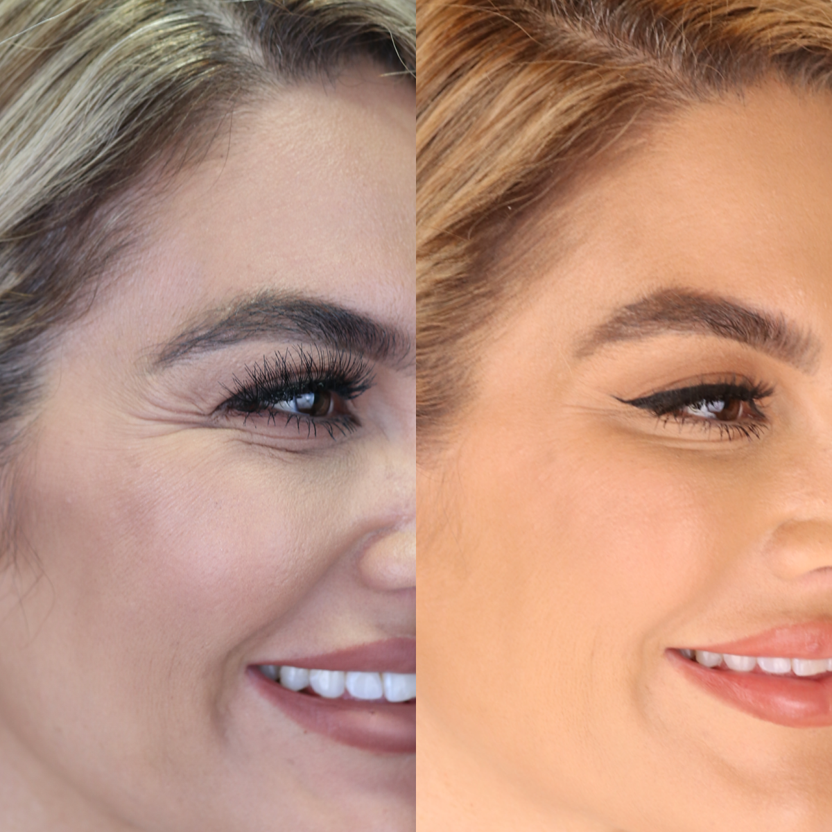 BOTOX® Injections | Lips | Frown Lines | Forehead | Armpits | Neck ...