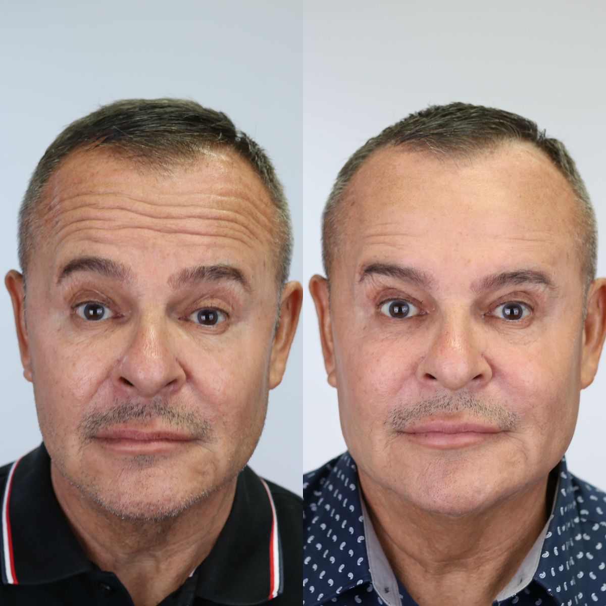 BOTOX® Injections | Lips | Frown Lines | Forehead | Armpits | Neck ...