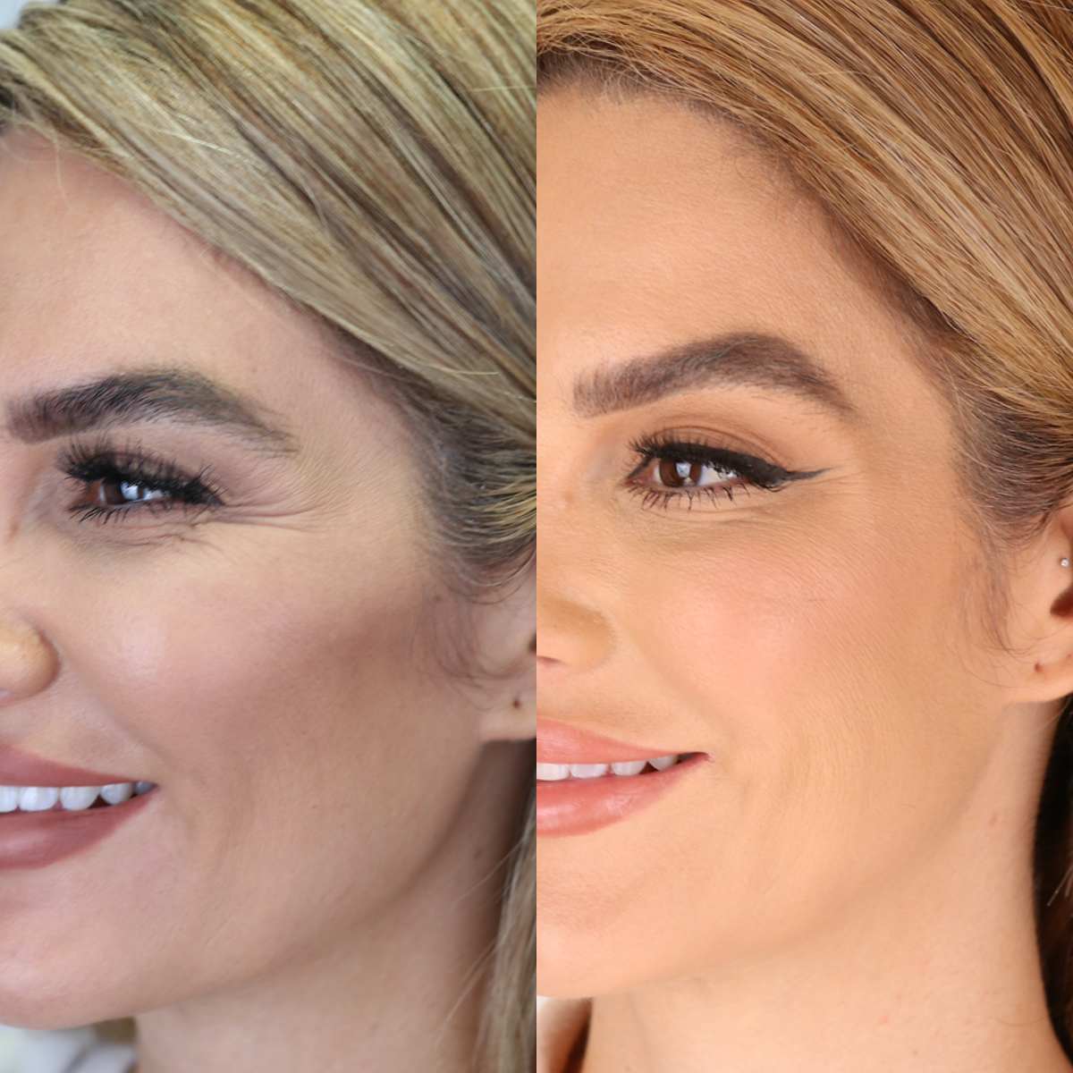 BOTOX® Injections | Lips | Frown Lines | Forehead | Armpits | Neck ...