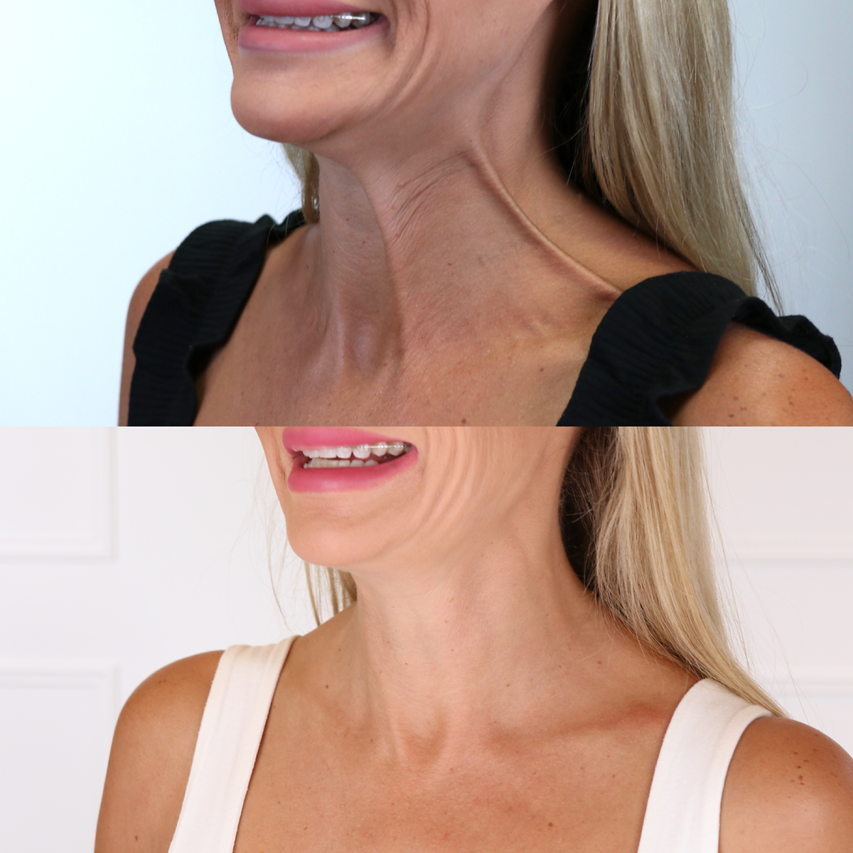 BOTOX® Injections | Lips | Frown Lines | Forehead | Armpits | Neck ...