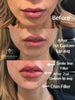 Custom Lip Augmentation