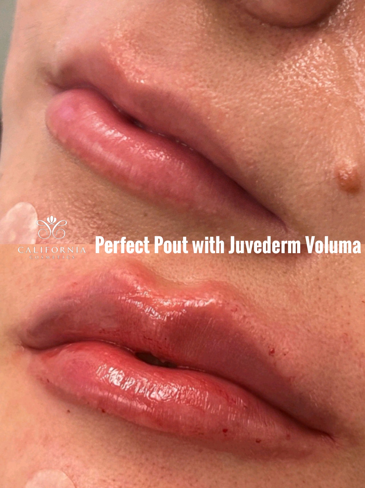 Lip Flip Procedure Keyhole Pout Russian Lip Filler Technique
