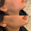 Jawline contouring and reshaping - before and after photos from the California Cosmetics Med Spa in Corona.