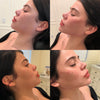 Jawline contouring and reshaping - before and after photos from the California Cosmetics Med Spa in Newport Beach.