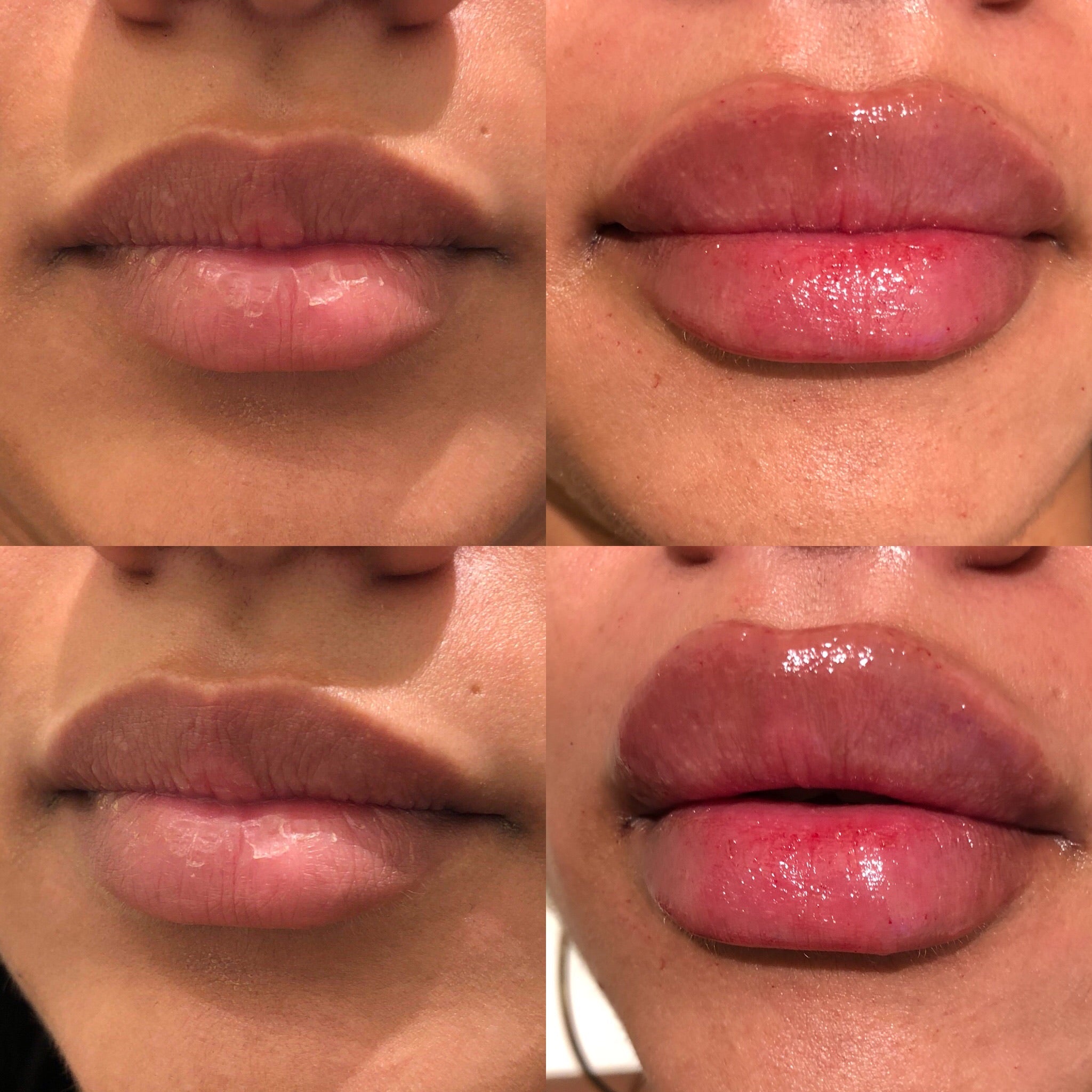 Lip Filler Injections Lip Flip Procedure Laugh Lines Treatment