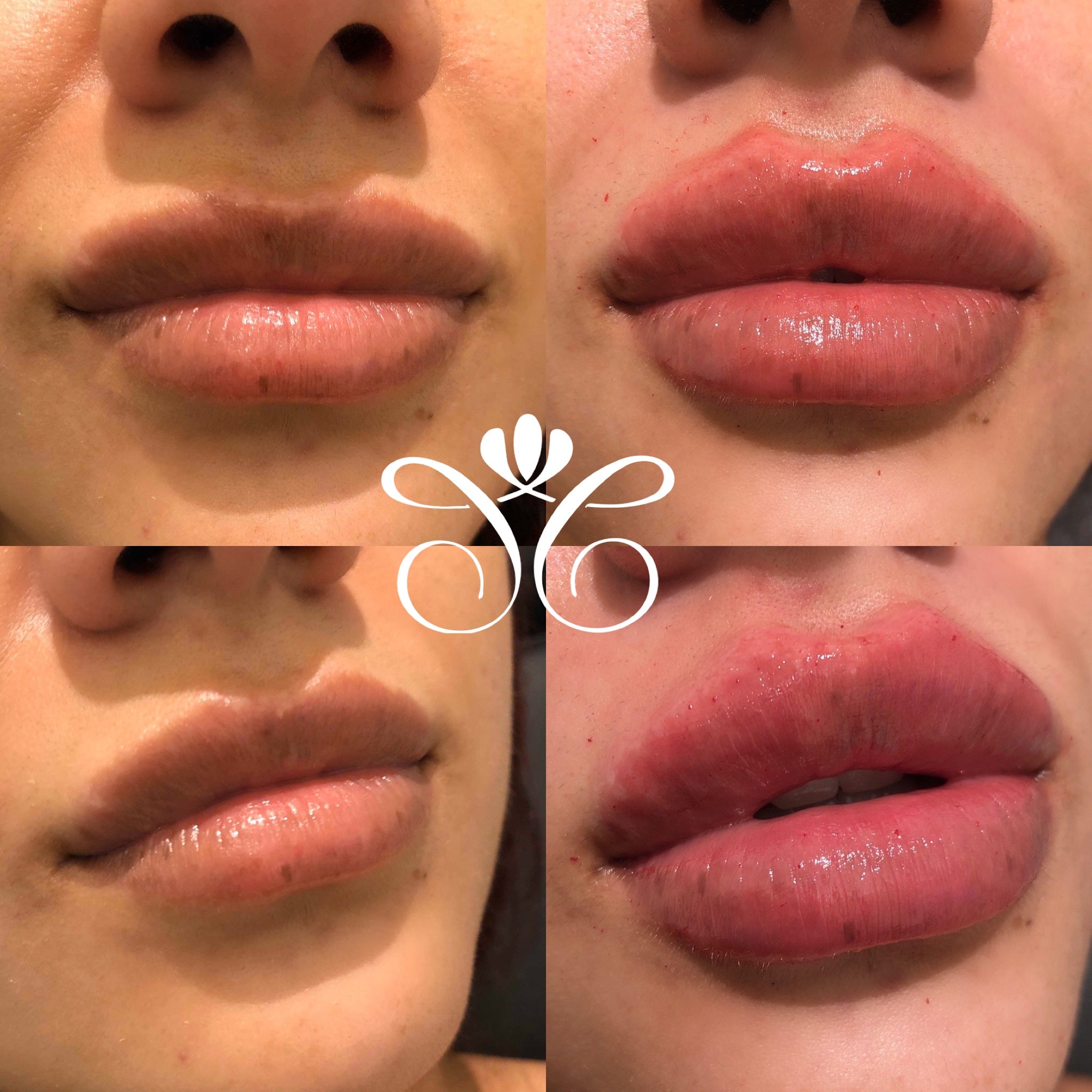 Lip Filler Injections Lip Flip Procedure Laugh Lines Treatment