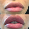 Custom Lip Augmentation