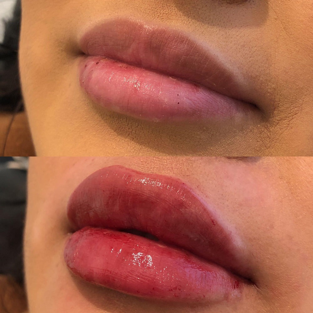 Lip Filler Injections Lip Flip Procedure Laugh Lines Treatment