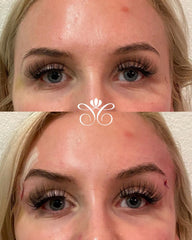 Non surgical brow lift procedures performed at the California Cosmetics Med Spa in Corona.