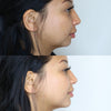 Non surgical chin augmentation before and after photos from the California Cosmetics Med Spa in Corona.