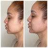 Non surgical chin augmentation before and after photos from the California Cosmetics Med Spa in Newport Beach.