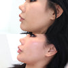 Non surgical chin reshaping procedure carried out at California Cosmetics Med Spa.