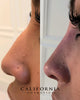 Nonsurgical Nose Job (NSNJ)