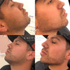 Creating the snatched jawline look at the California Cosmetics Med Spa in Corona.